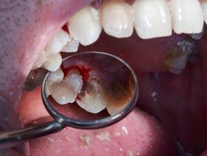 zobje, ustna higiena