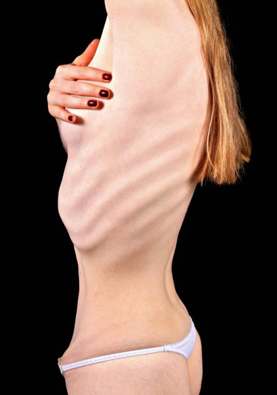 anoreksija | Avtor: Shutterstock