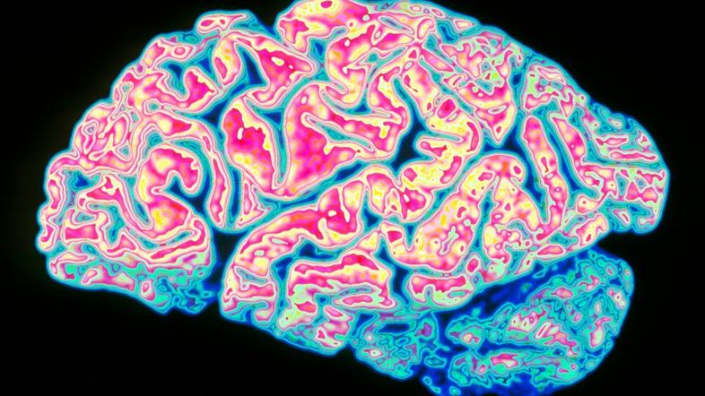 Možgani Alzheimerjeva bolezen