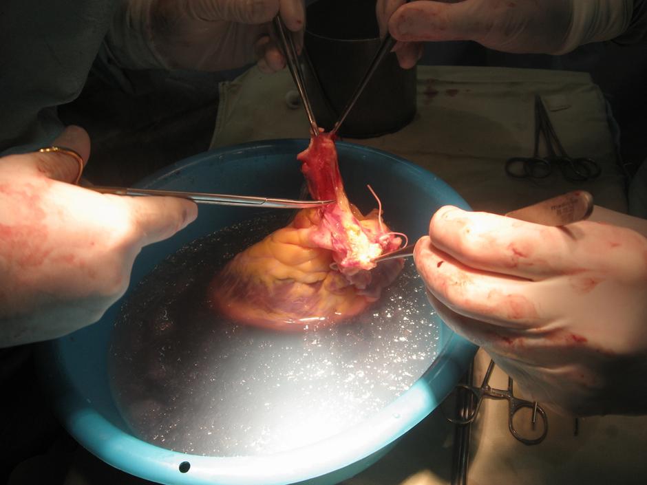 Transplantacija srca | Avtor: Shutterstock