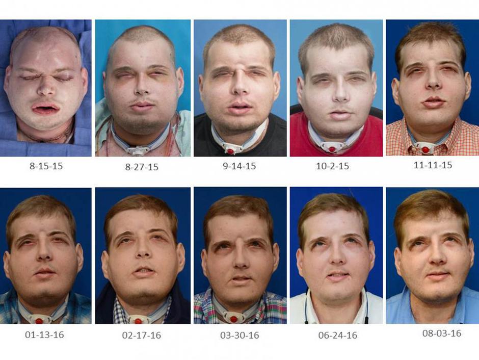 Presaditev obraza | Avtor: Profimedias