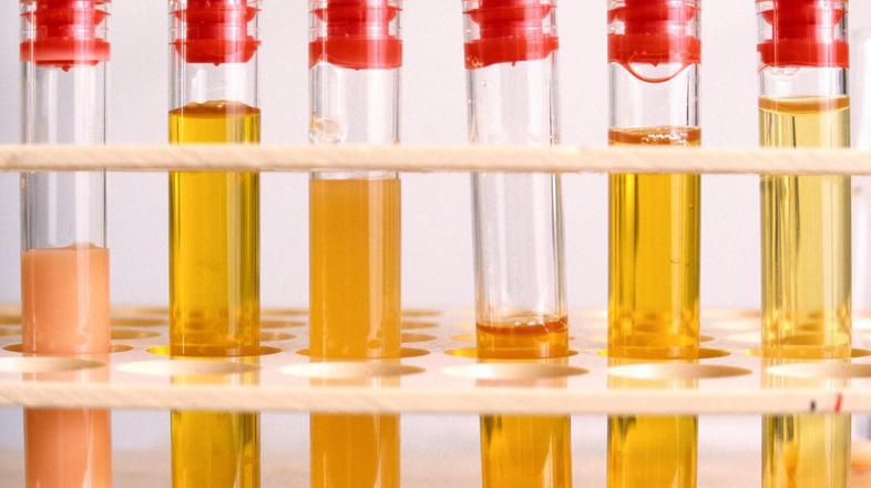 Hiperholesterolemija