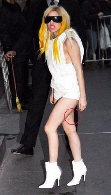 Lady Gaga modrice