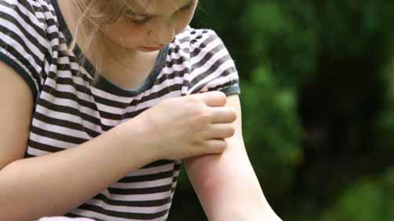 Zaradi odkritja "celice srbenja" bo v prihodnosti lajšanje srbečice lažje.