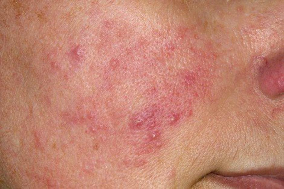 Rosacea | Avtor: Profimedia