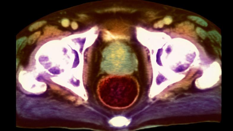 Rak prostate