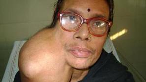 67-letna Indijka je z odstranitvijo tumorja odlašala tako dolgo, ker se je bala,