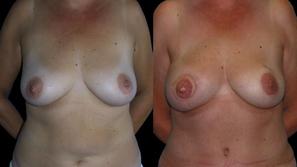 Levo fotografija bolnice z rakom dojke pred operacijo, desno po operaciji. Za no