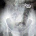 Rentgenska slika je pokazala, da ima pacientka v anusu veliko pločevinko.