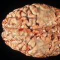 Meningitis možgani