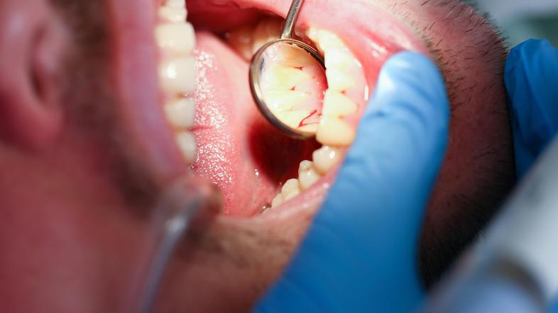 Zobje zobozdravnik karies