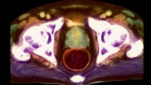 Rak prostate