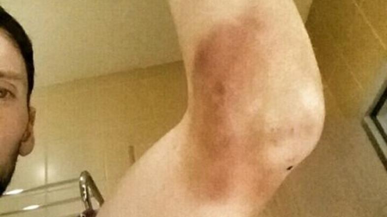 jakov fak komolec poškodba