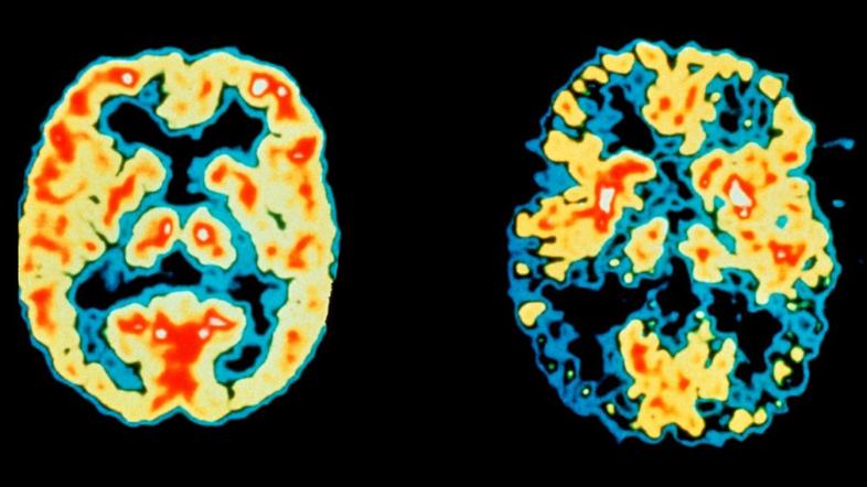 Normalni možgani in možgani bolnika z Alzheimerjevo boleznijo