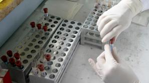 Laboratorij HIV AIDS epruvete iStock