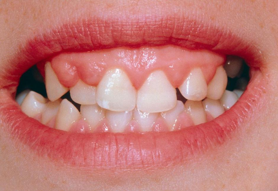 Gingivitis | Avtor: Profimedias