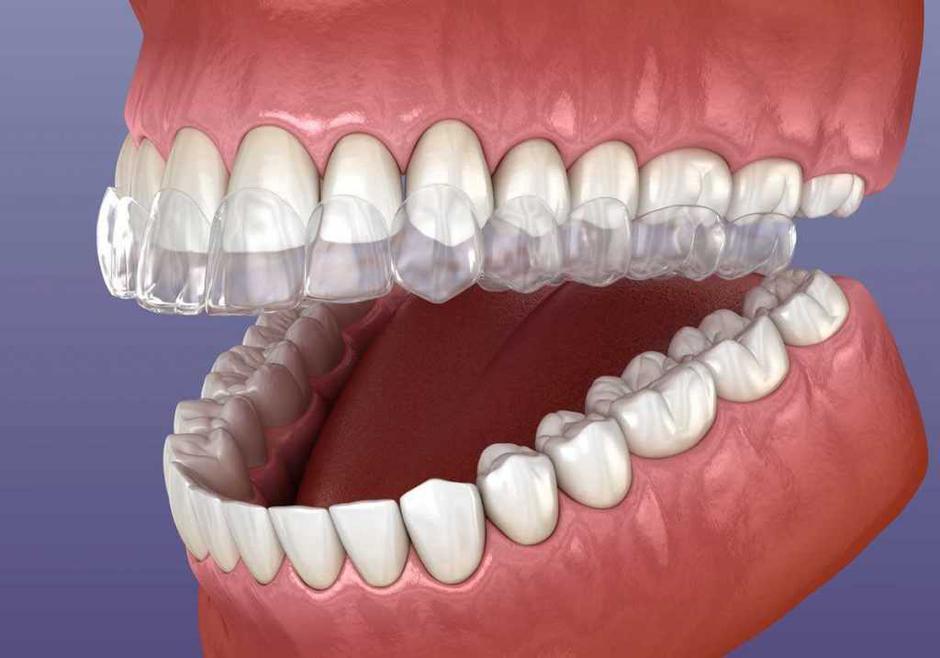 invisalign, zobje, estetetika, zdravje | Avtor: Invisalign