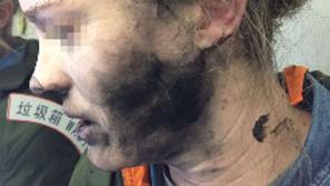 Opečena zaradi litij-ionskih baterij