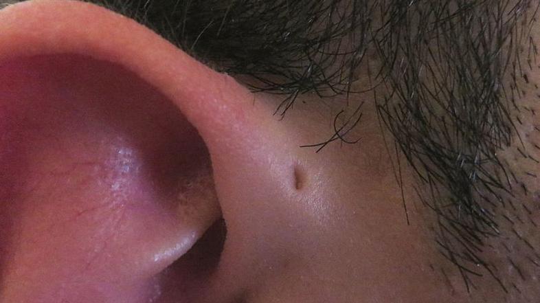  preauricular sinu