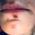 Impetigo