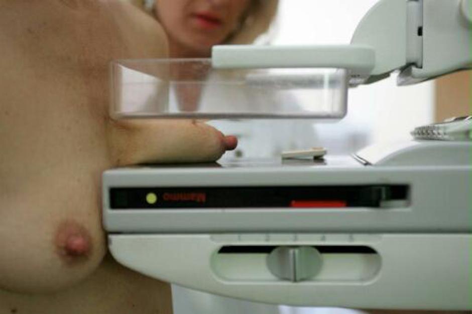 Mamografija dojke BOBO | Avtor: Žurnal24 main