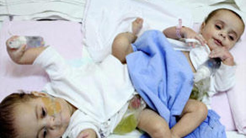 Egipčanska dvojčka Hassan in Mahmoud okrevata po zahtevni operaciji.