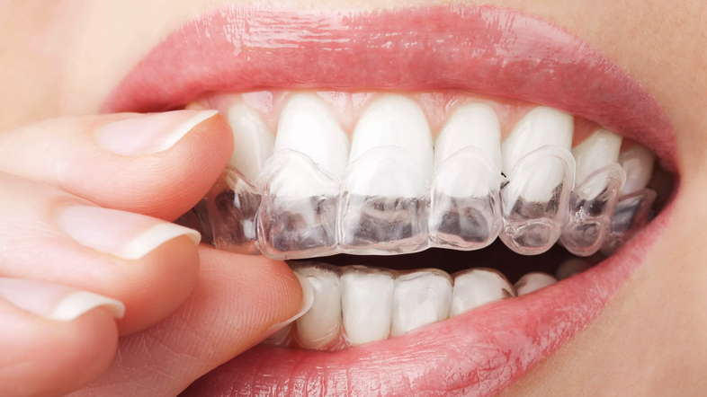 invisalign, zobje, estetetika, zdravje