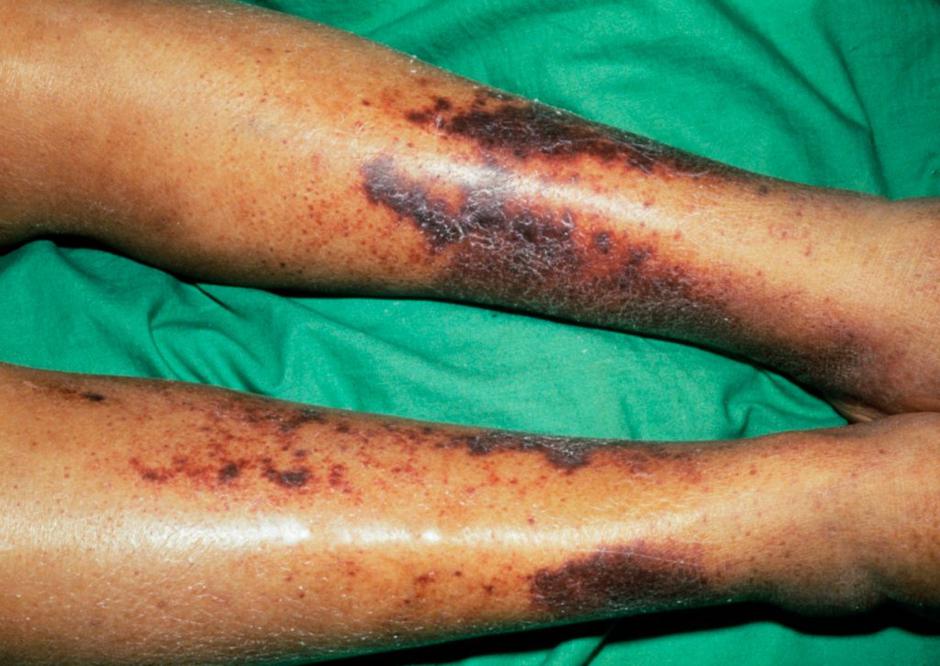 Pomanjkanje vitamina C | Avtor: Profimedias