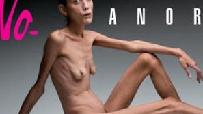Anoreksija je bolezen.
