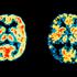Normalni možgani in možgani bolnika z Alzheimerjevo boleznijo