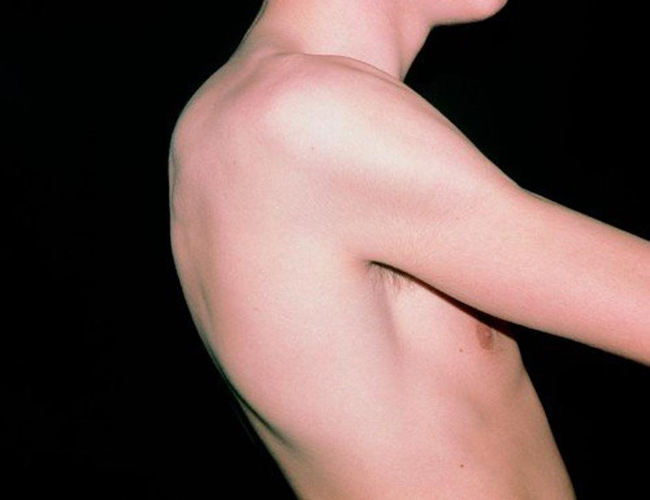 Kyphosis | Avtor: Profimedia