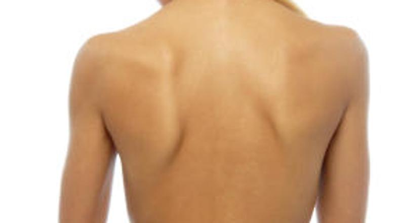 Pri ženskah so lahko še posebej nadležne bradavice pod prsmi.