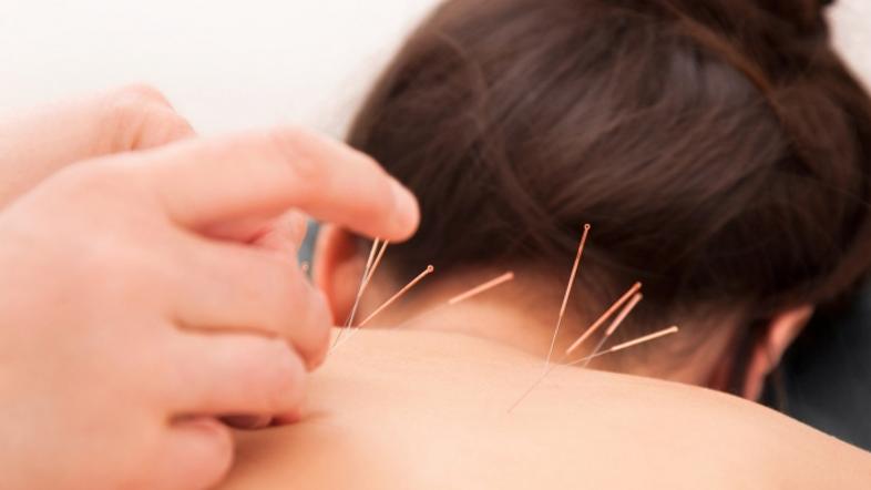 Zivljenje 10.06.13, akupunktura, foto: shutterstock