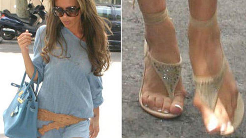 Victorijini nožni prsti so po fotografijah sodeč precej izmaličeni, največjo tež