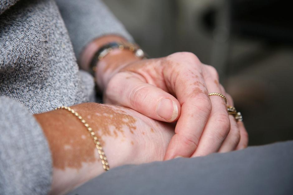 vitiligo, kožna bolezen, depigmentacija, bele lise | Avtor: Profimedia