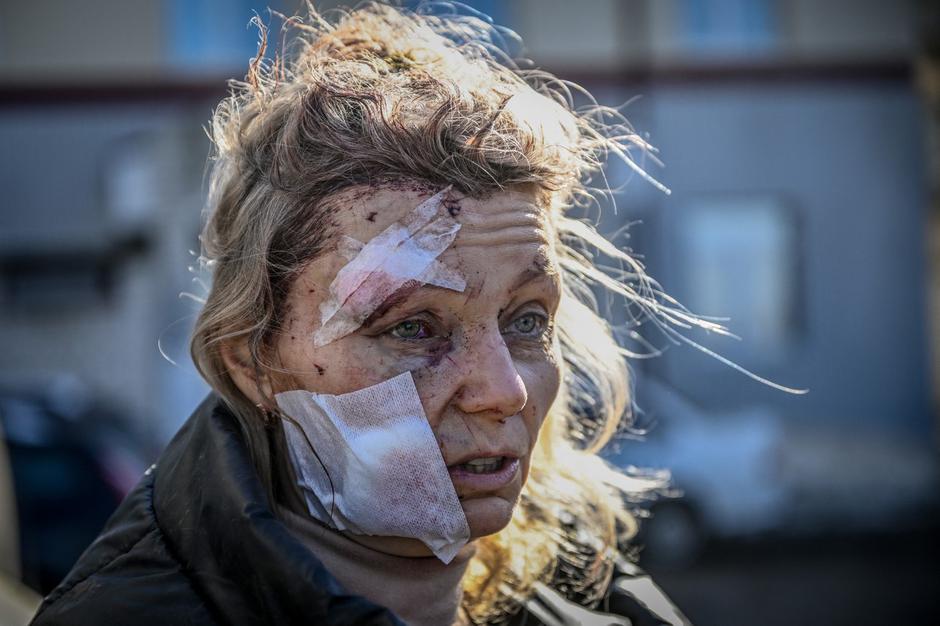 Ukrajinka, poškodovana v eksploziji | Avtor: Profimedia