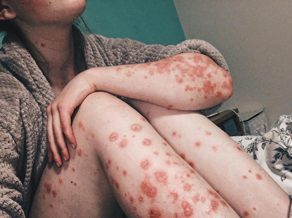 Huda oblike psoriaze | Avtor: Profimedia