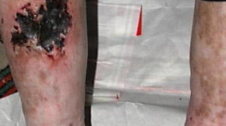 Jackove noge so bile hudo poškodovane zaradi injekcij zdravil.