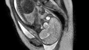 porod, snemanje, magnetna resonanca