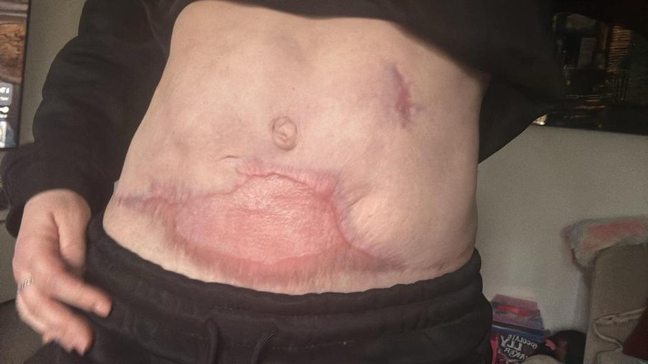 Ostale so ji brazgotine | Avtor: Profimedia