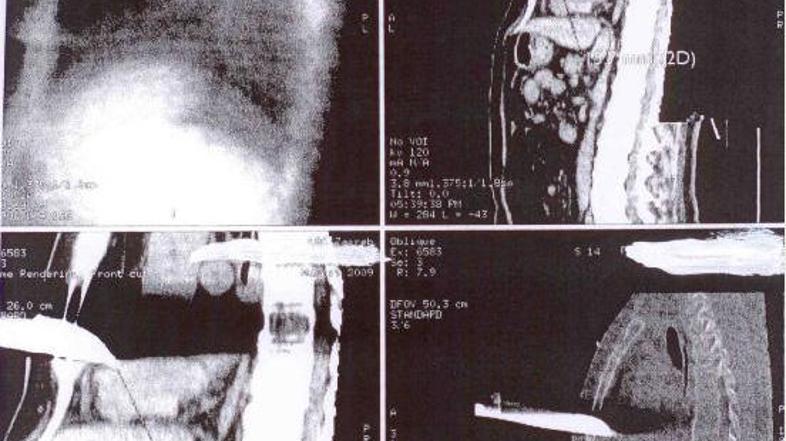 Globoko rano v desnem prekatu, ki jo je povzročil vbodnoža, so kirurgi uspeli za