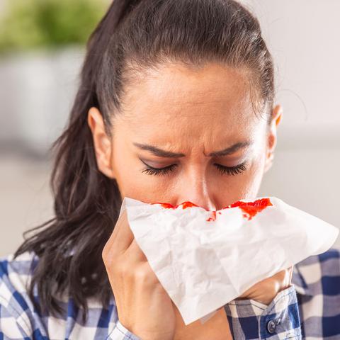 krvavitev iz nosu, kri iz nosu, epitaksa