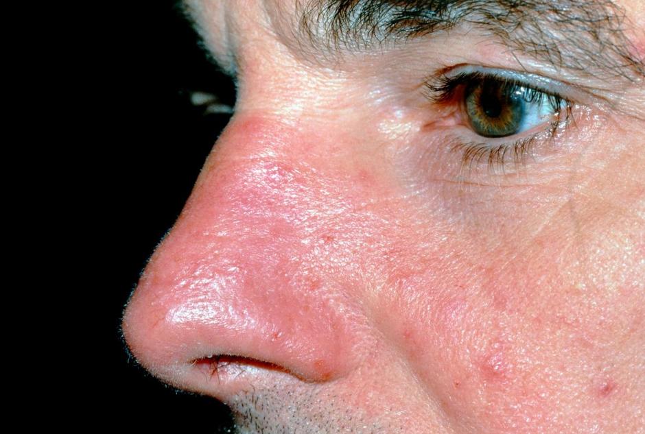 Rosacea | Avtor: Profimedias