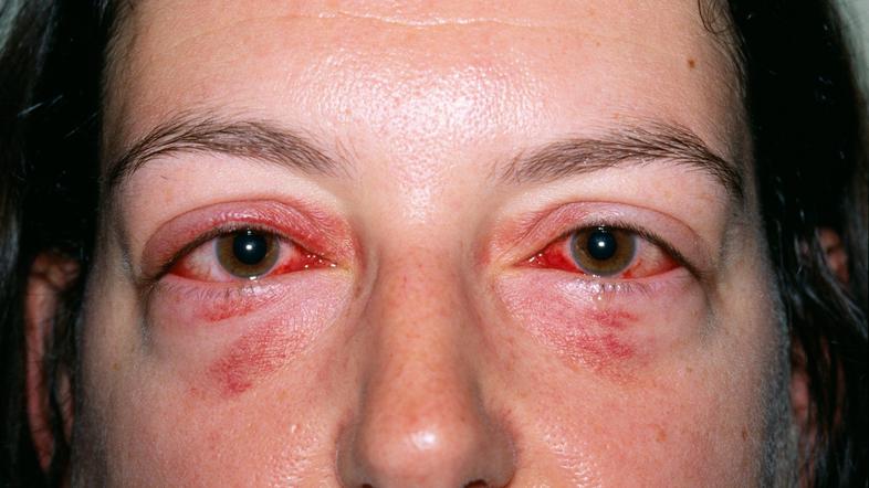 virusni konjuktivitis