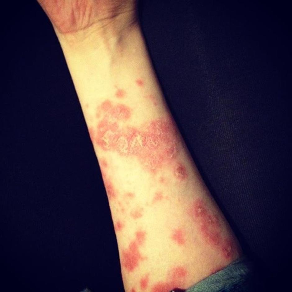 Huda oblike psoriaze | Avtor: Profimedia