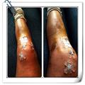 Vonn kolena koleni poškodba operacija smučanje SP Schladming