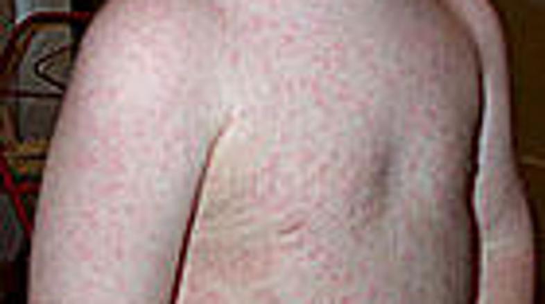 V nekaterih evropskih državah je bilo proti ošpicam cepljenih manj kot 80 odstot