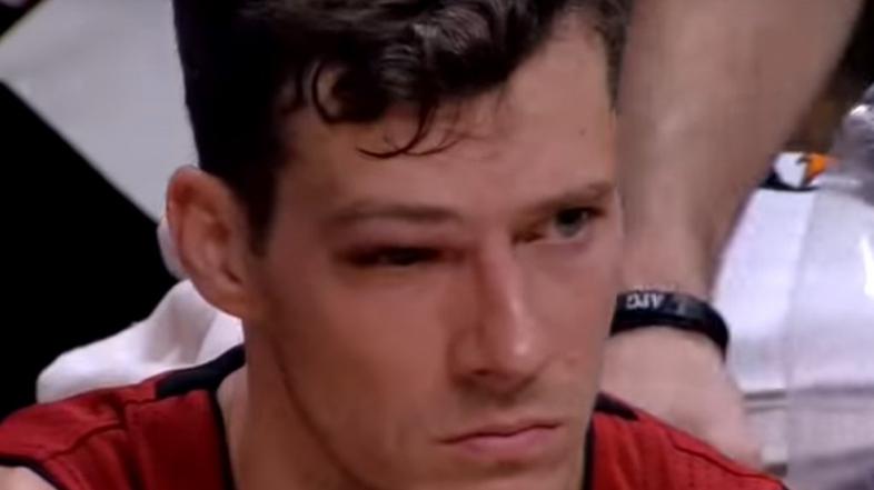 Goran Dragić poškodba očesa