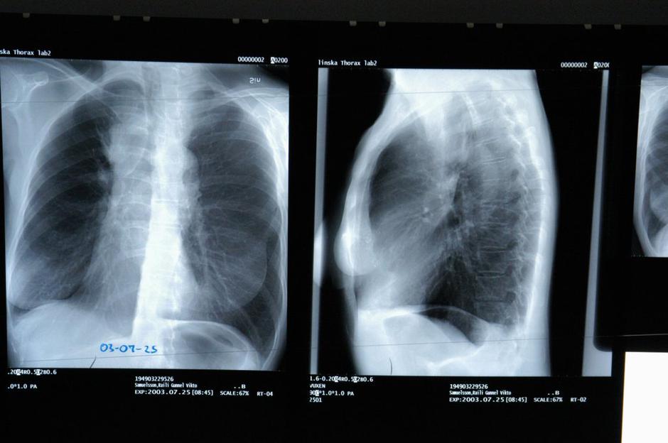 Pljučni rak | Avtor: Profimedias