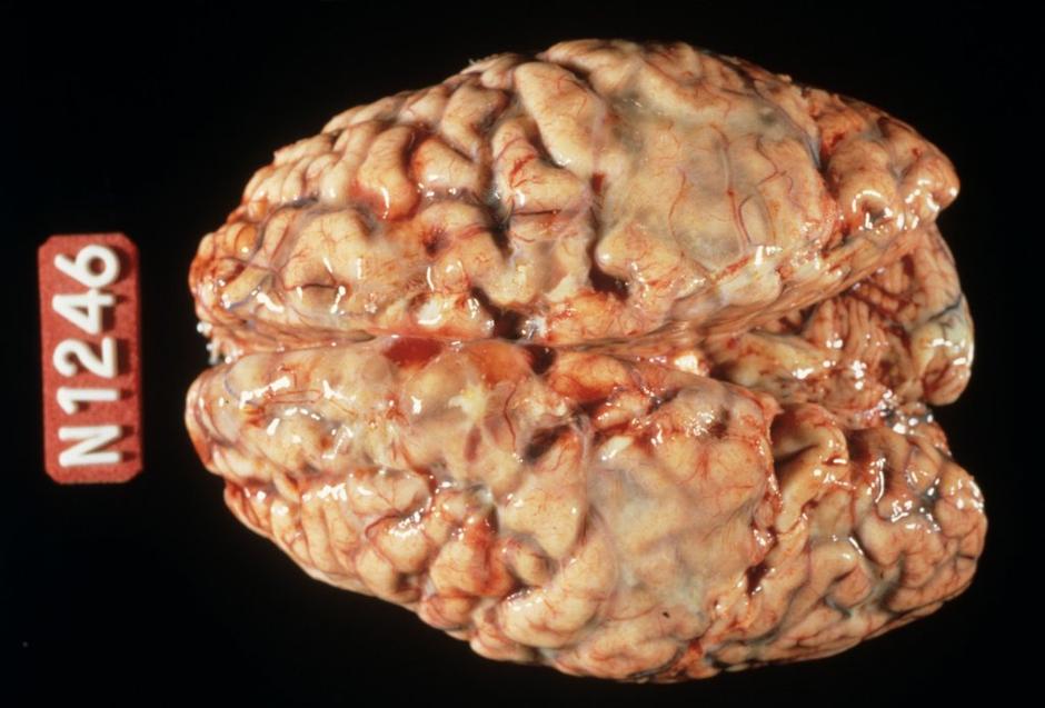 Meningitis možgani | Avtor: Profimedias